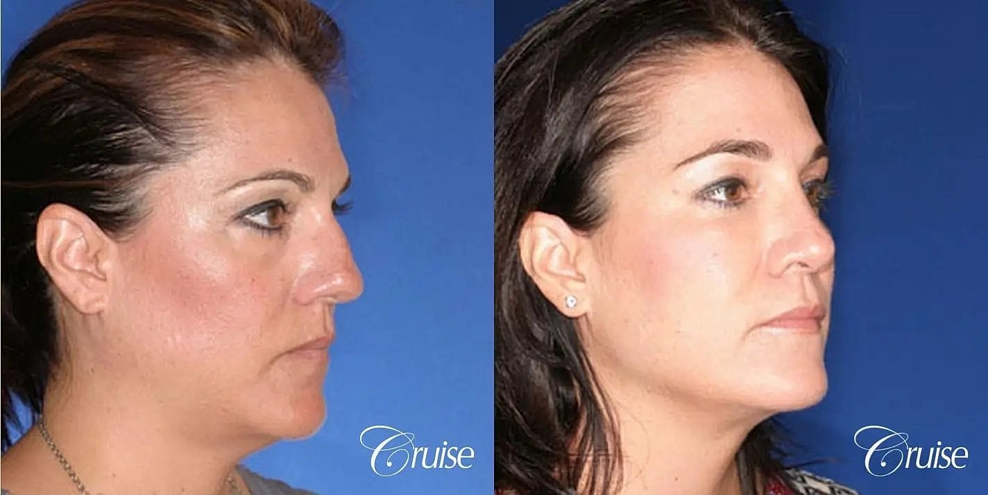 Rhinoplasty Before & After