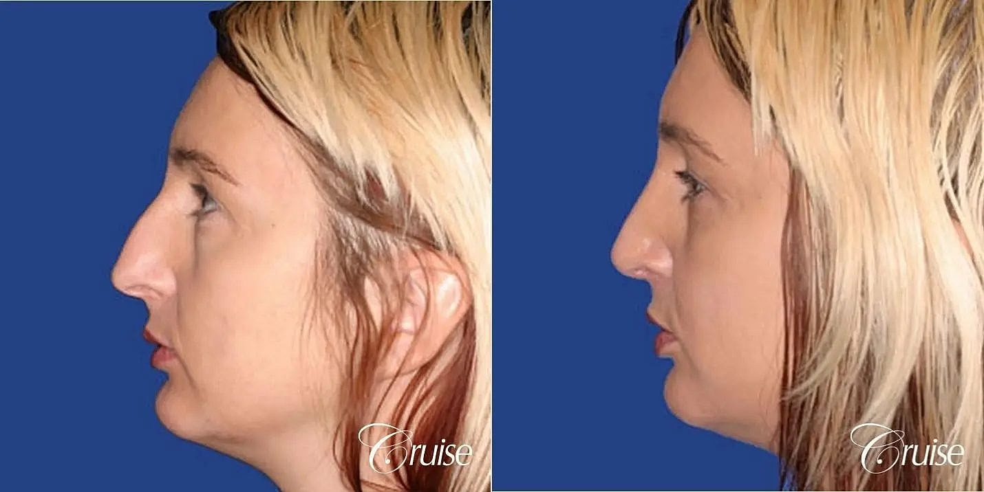 Rhinoplasty Before & After
