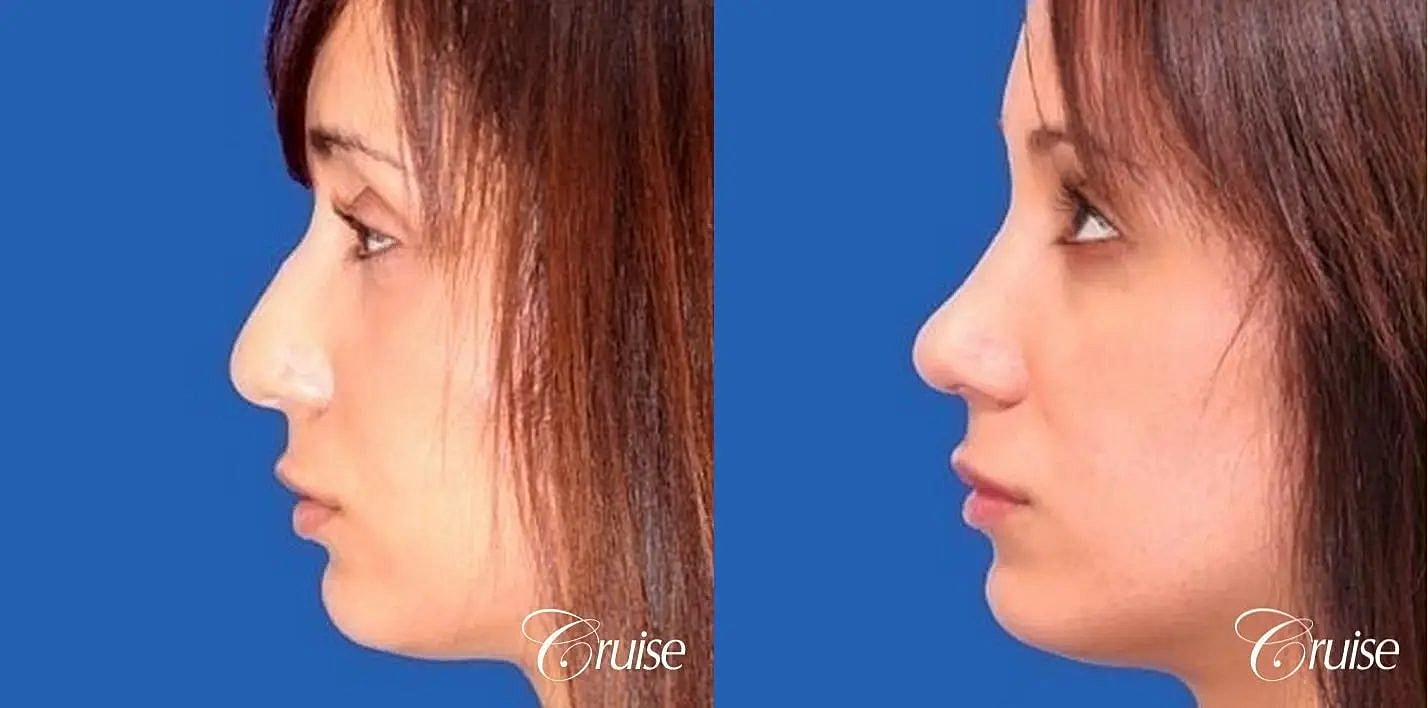 Rhinoplasty Before & After