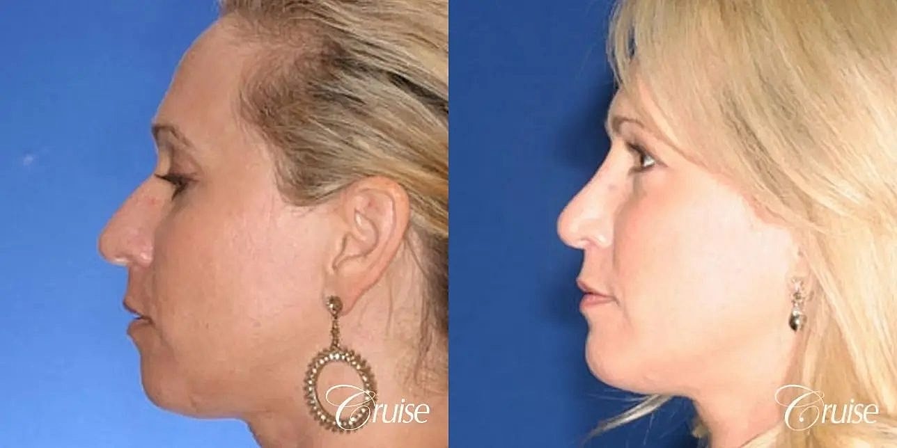 Rhinoplasty Before & After
