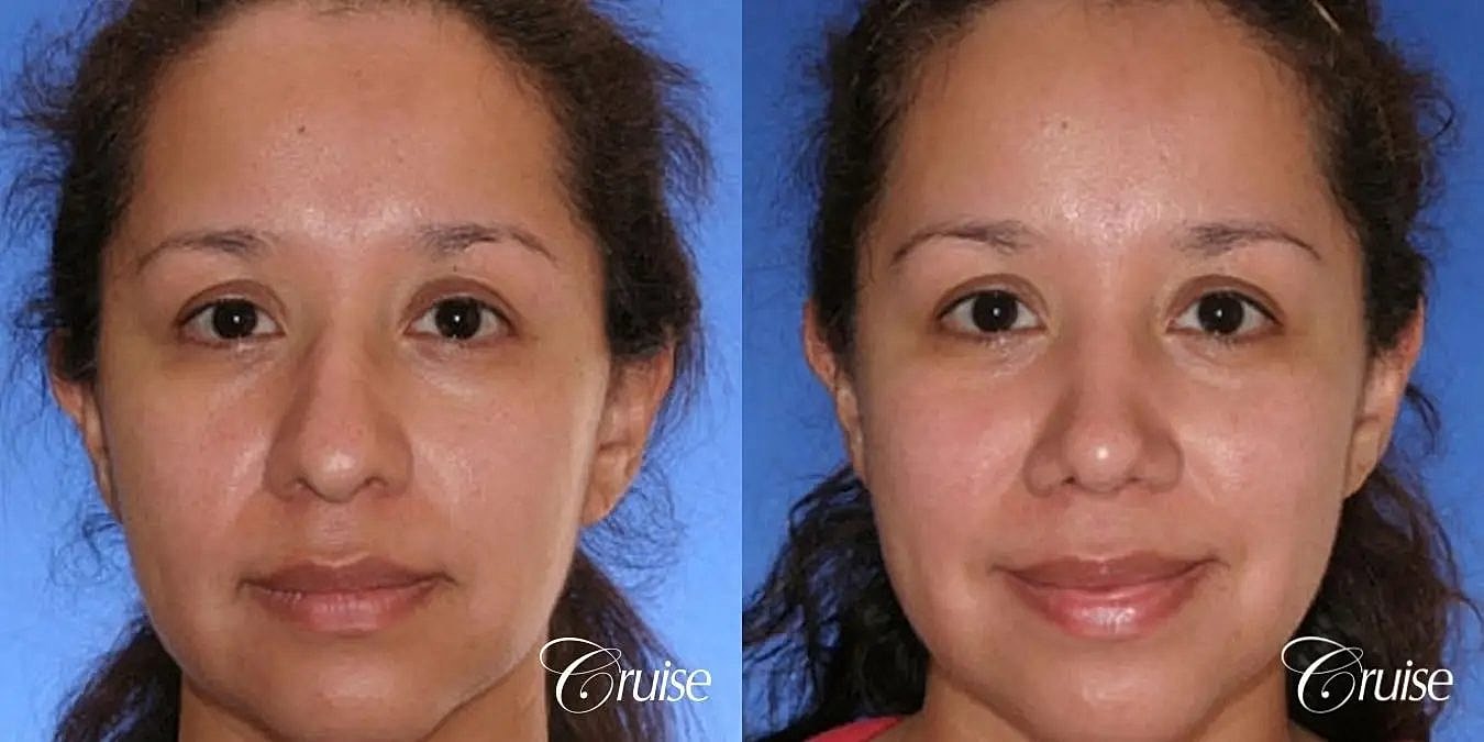 Rhinoplasty Before & After