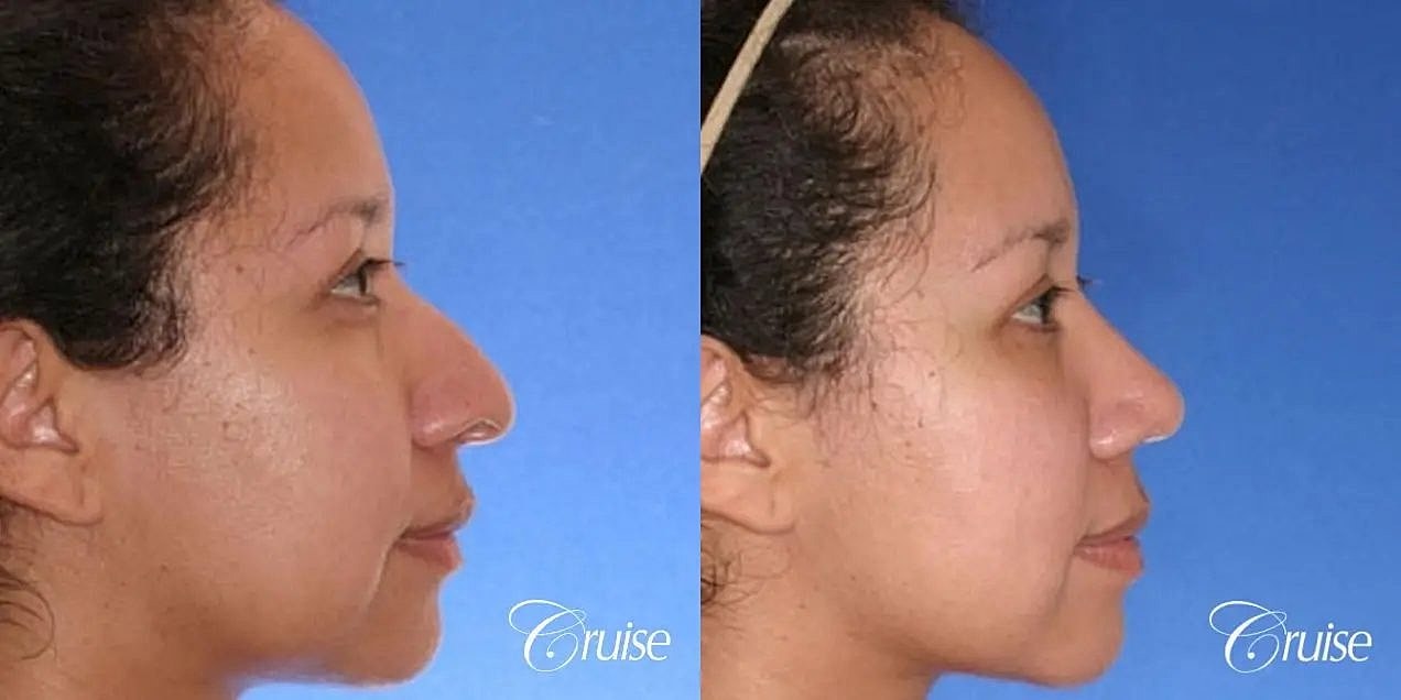 Rhinoplasty Before & After