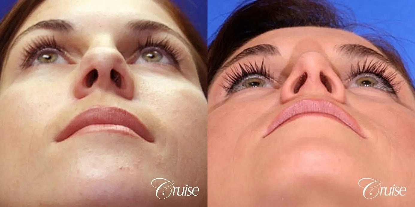 Rhinoplasty Before & After