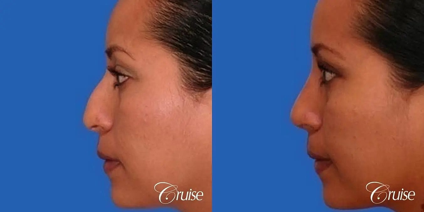 Rhinoplasty Before & After