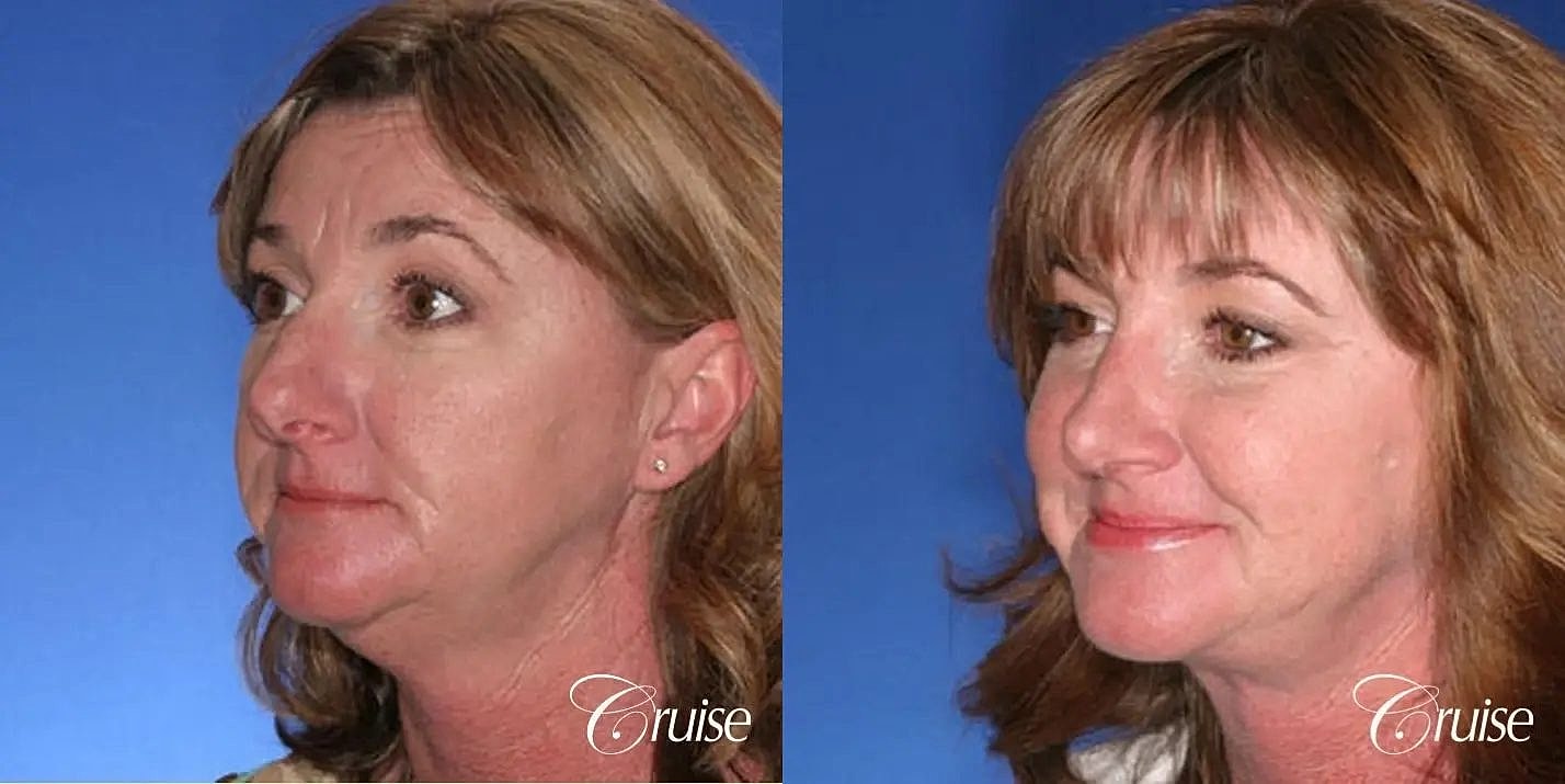 Rhinoplasty Before & After