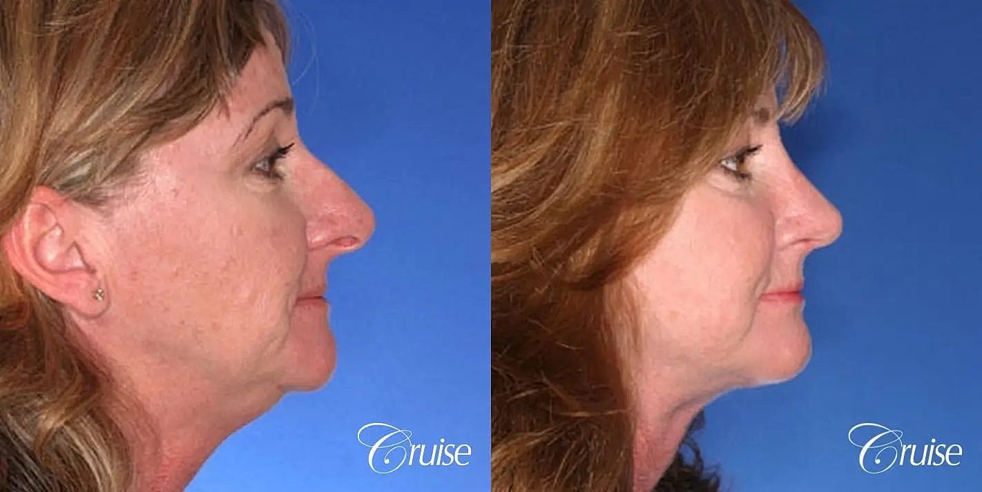 Rhinoplasty Before & After