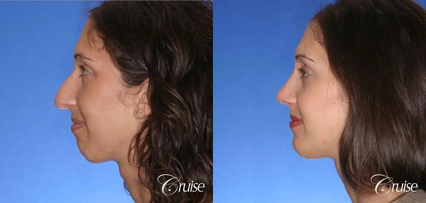 Rhinoplasty Before & After
