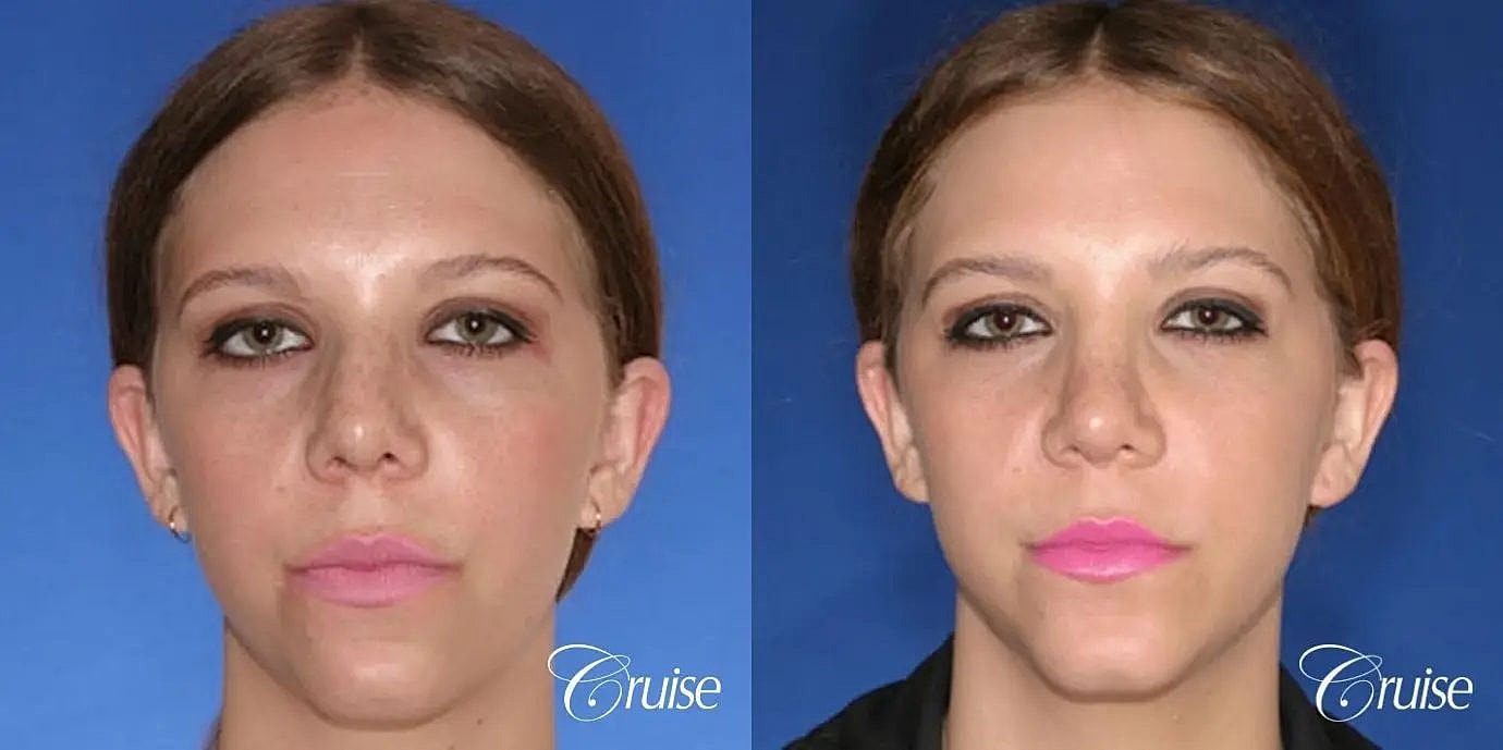 Rhinoplasty Before & After
