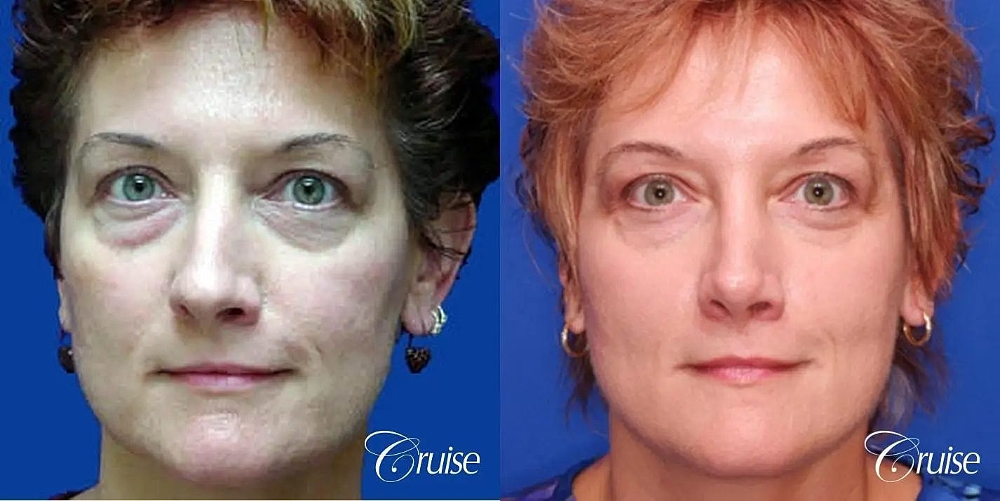 Rhinoplasty Before & After