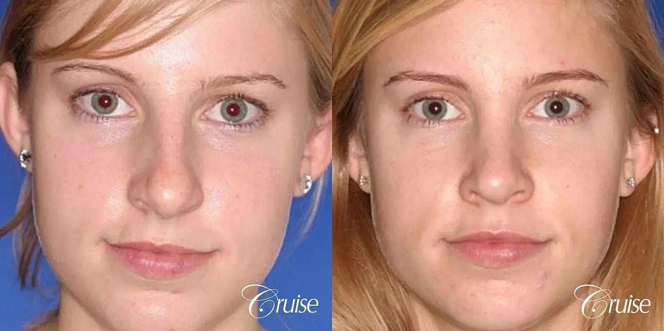 Rhinoplasty Before & After