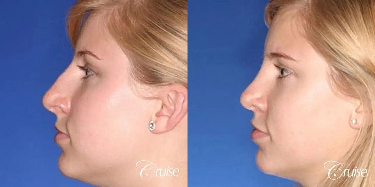 Rhinoplasty Before & After