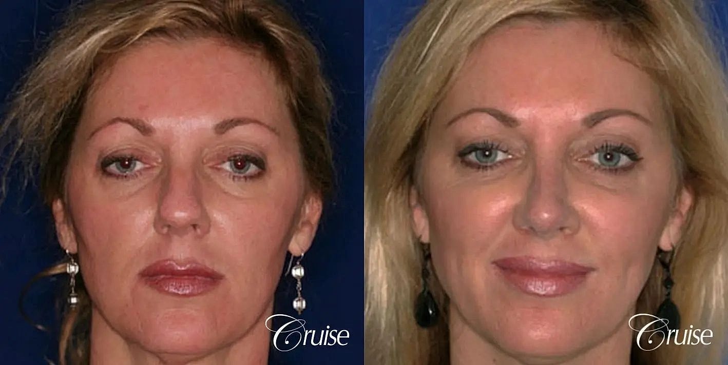 Rhinoplasty Before & After