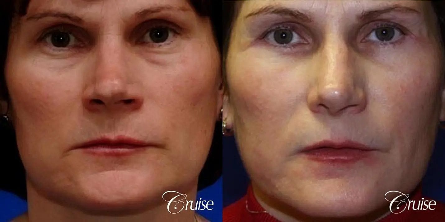 Rhinoplasty Before & After