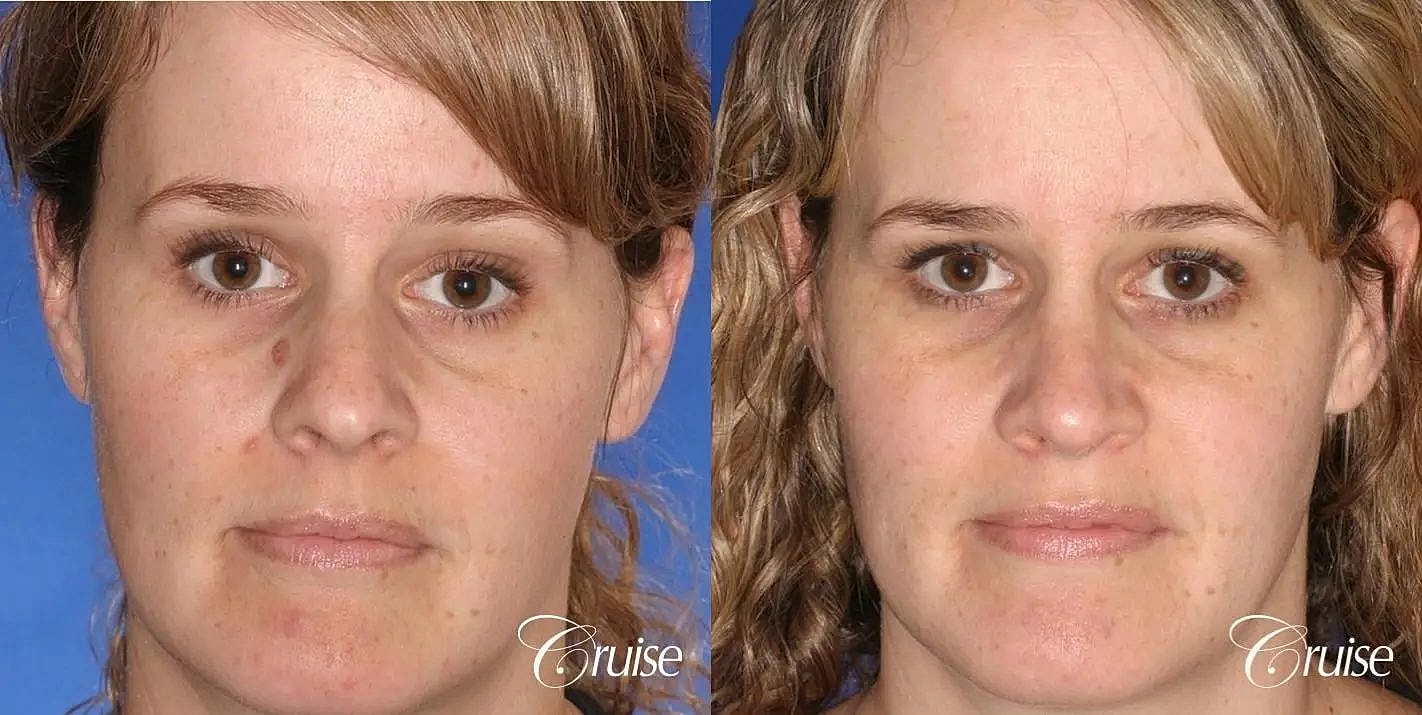 Rhinoplasty Before & After