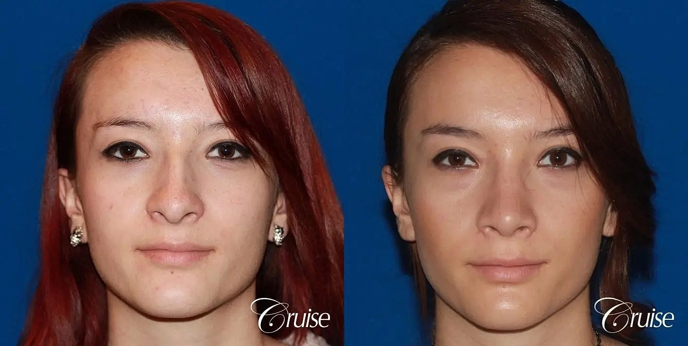 Rhinoplasty Before & After