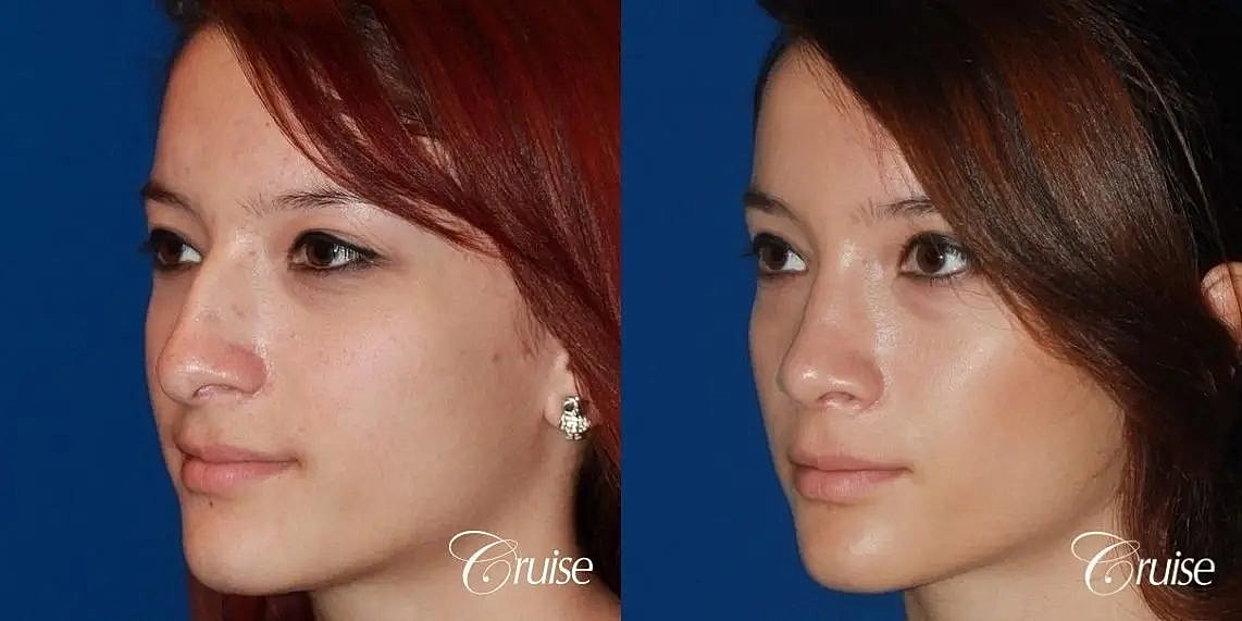 Rhinoplasty Before & After