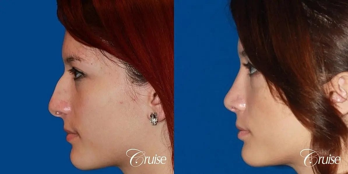Rhinoplasty Before & After