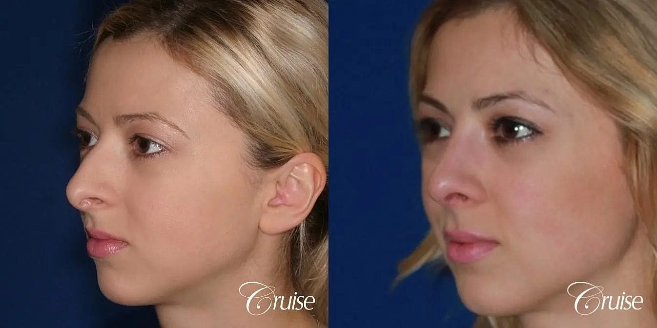 Rhinoplasty Before & After