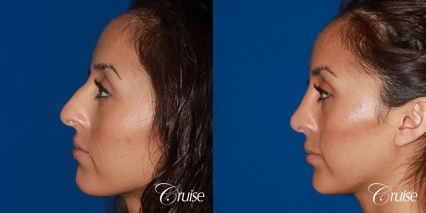 Rhinoplasty Before & After