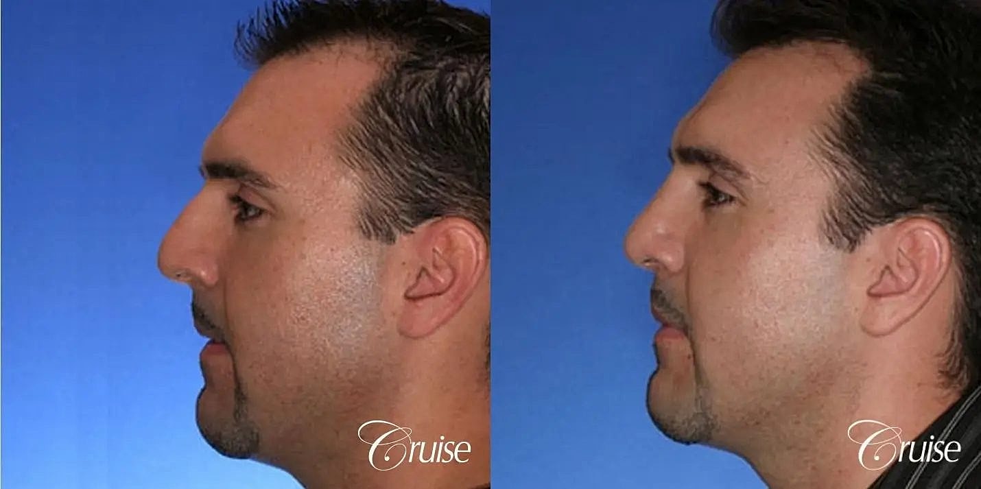 Rhinoplasty Before & After