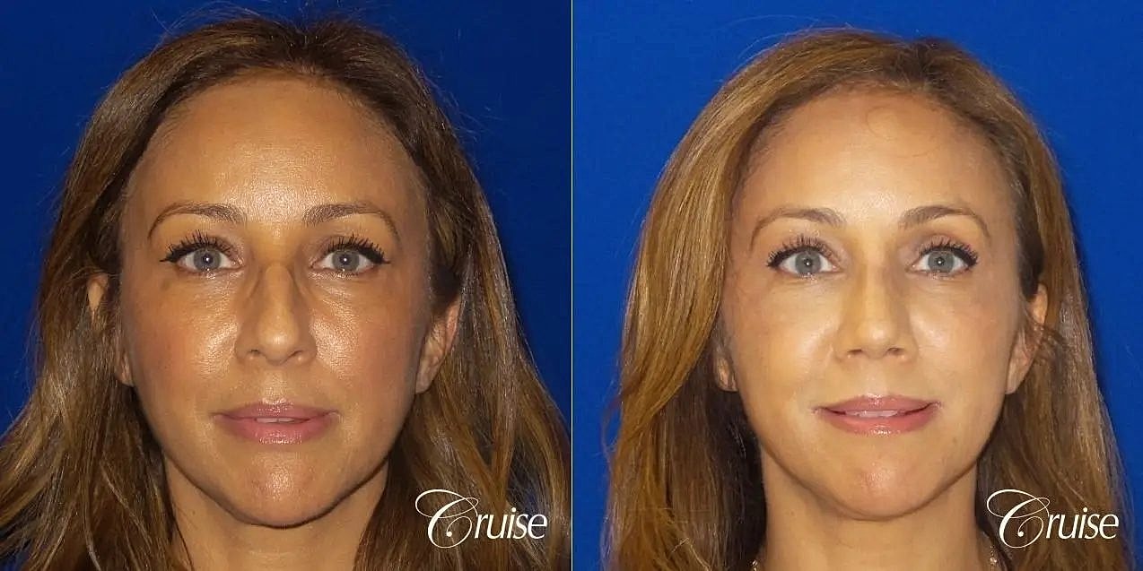 Rhinoplasty Before & After