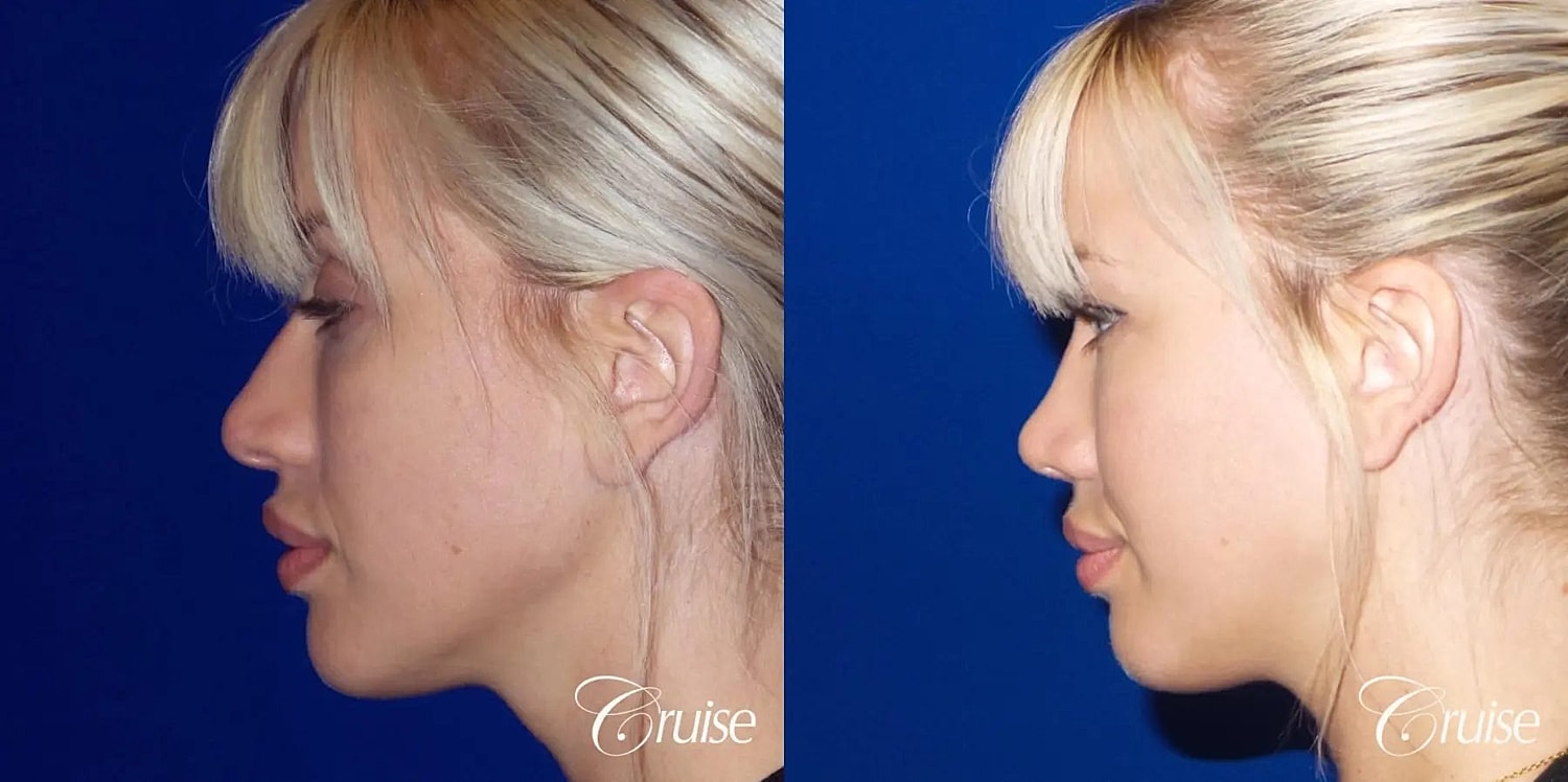 Rhinoplasty Before & After