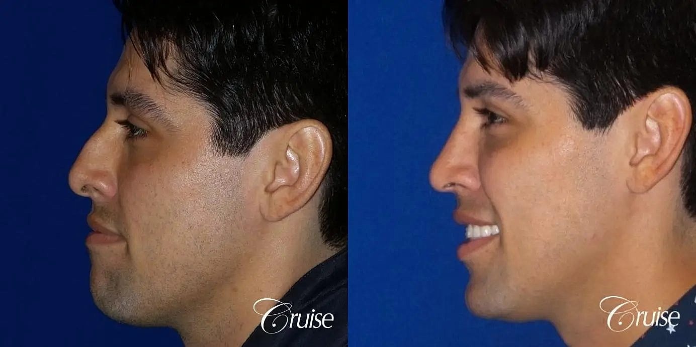 Rhinoplasty Before & After