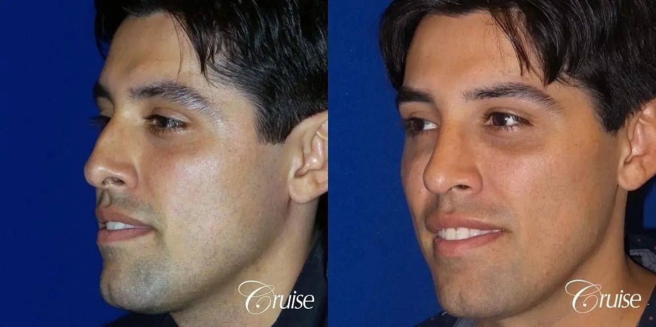 Rhinoplasty Before & After