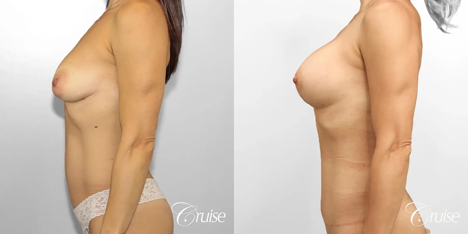 Mommy Makeover Before & After