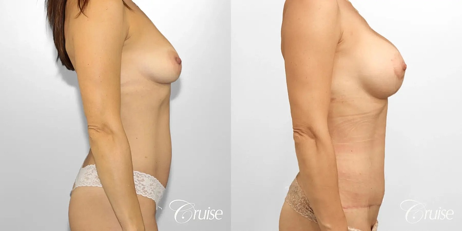 Mommy Makeover Before & After