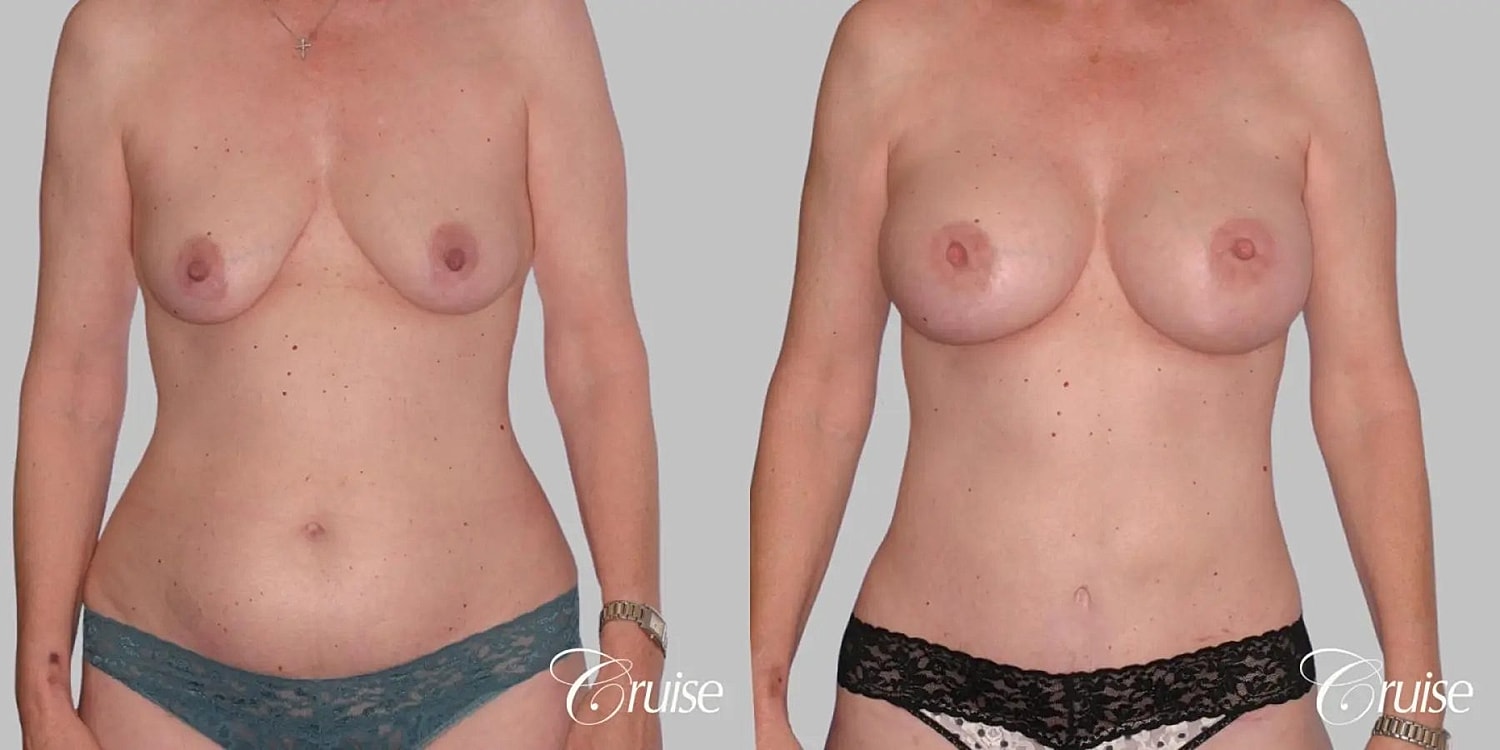 Mommy Makeover Before & After