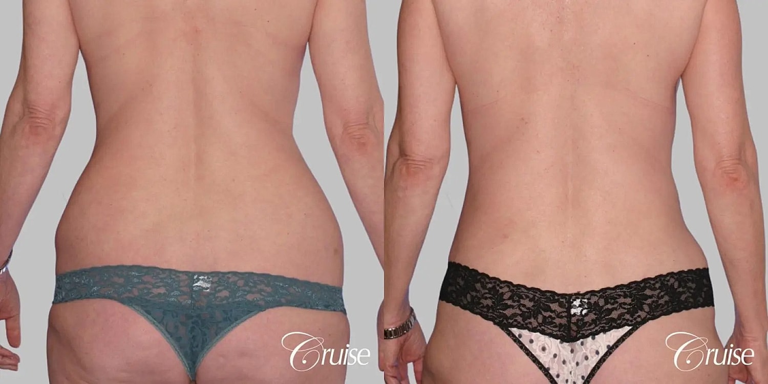 Mommy Makeover Before & After