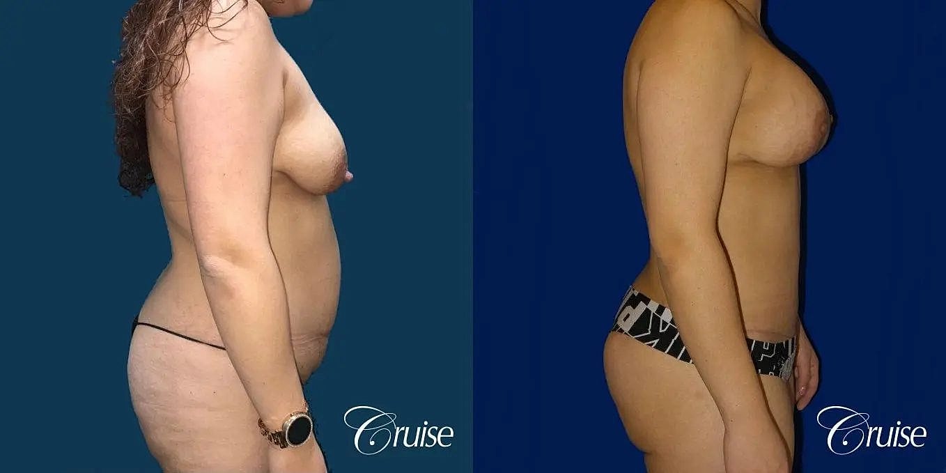 Mommy Makeover Before & After