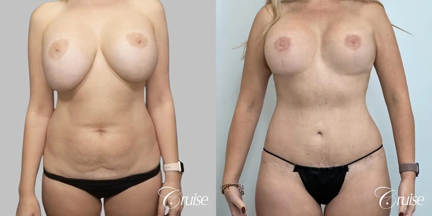 Mommy Makeover Before & After