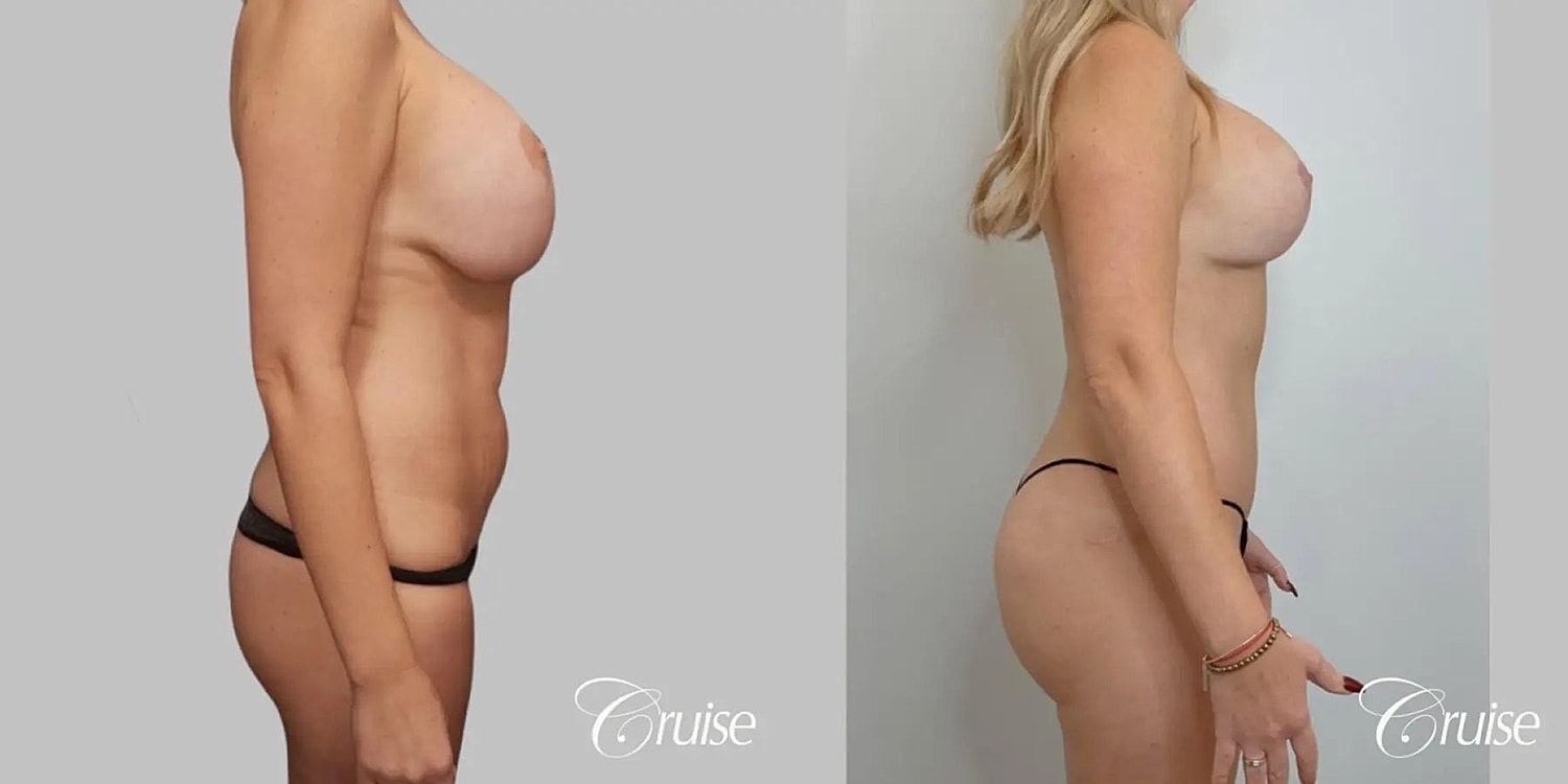 Mommy Makeover Before & After