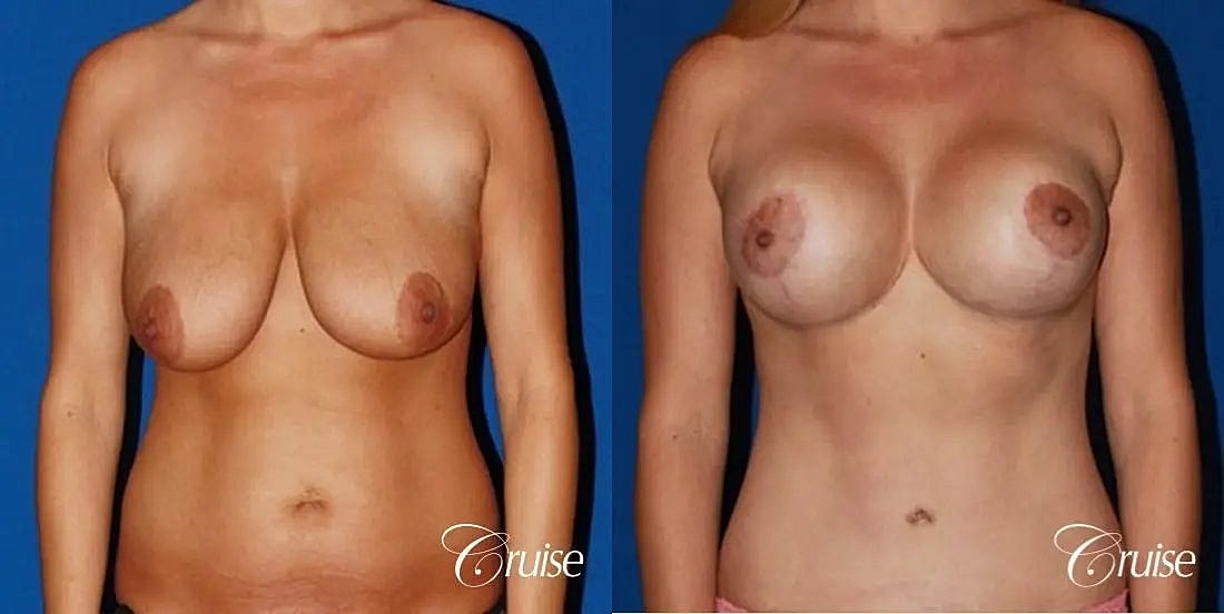 Mommy Makeover Before & After