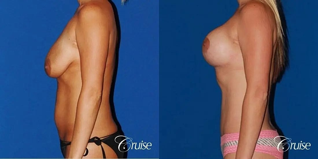 Mommy Makeover Before & After