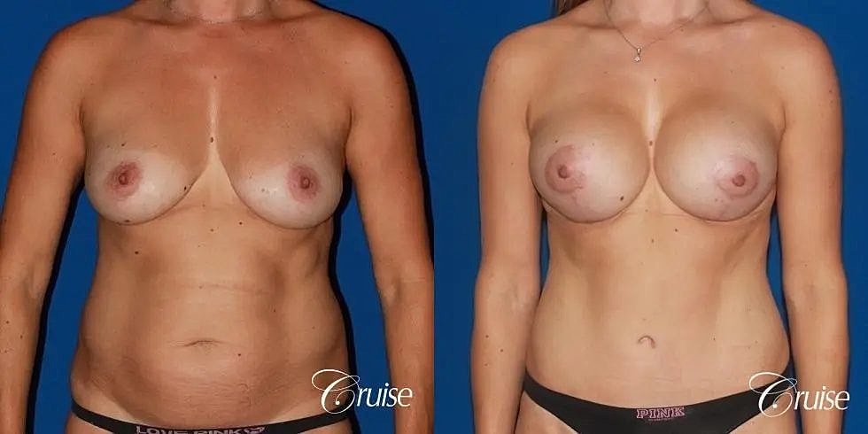 Mommy Makeover Before & After