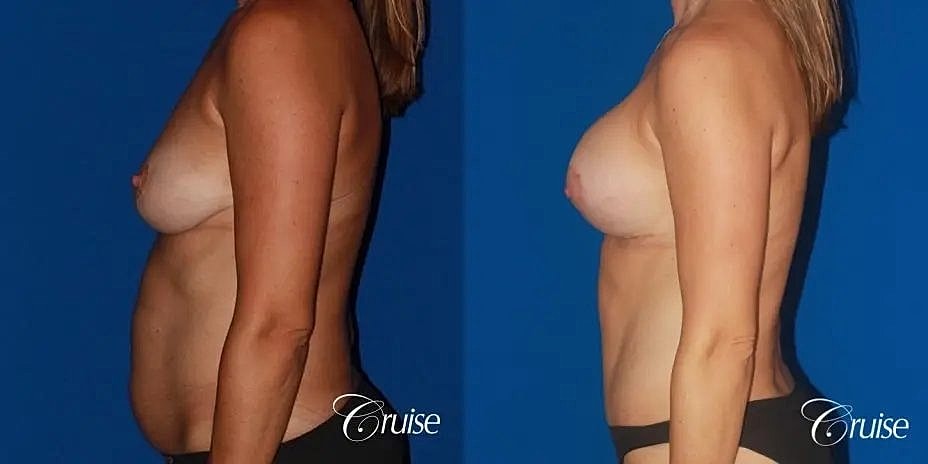 Mommy Makeover Before & After