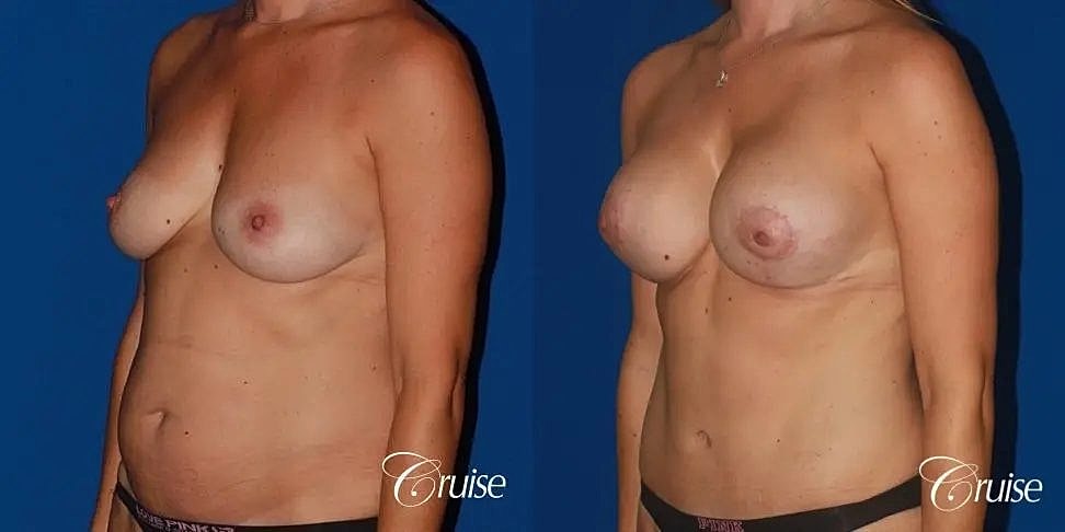 Mommy Makeover Before & After