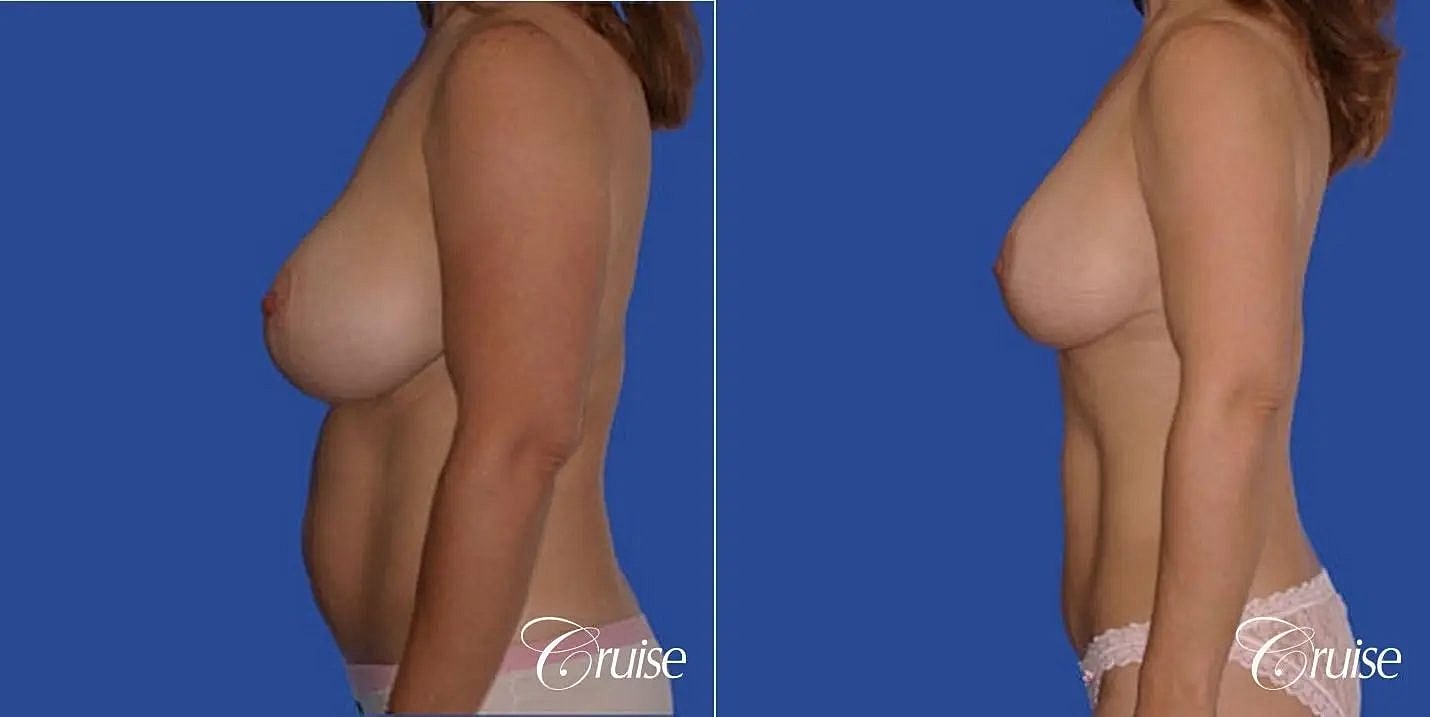 Mommy Makeover Before & After