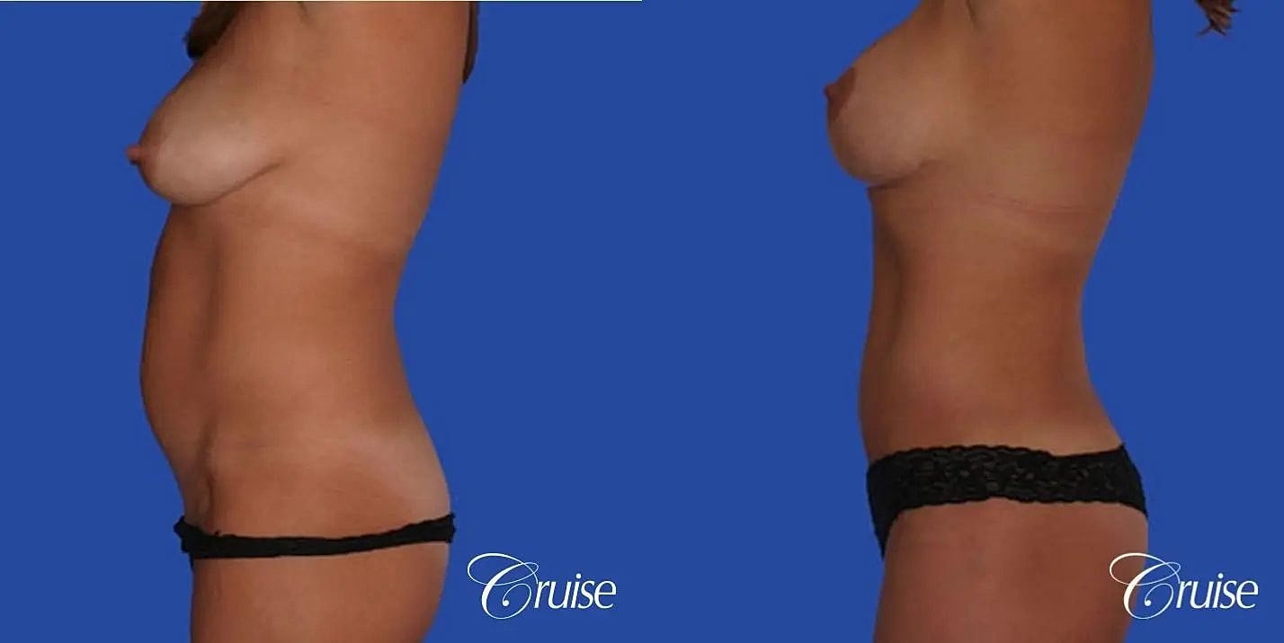 Mommy Makeover Before & After