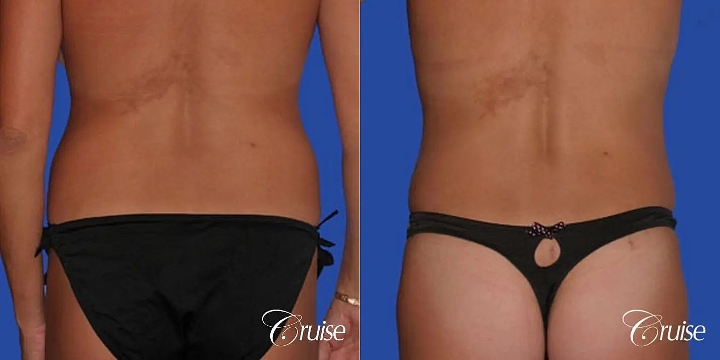 Mommy Makeover Before & After