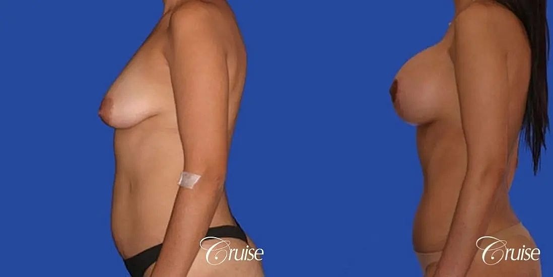 Mommy Makeover Before & After