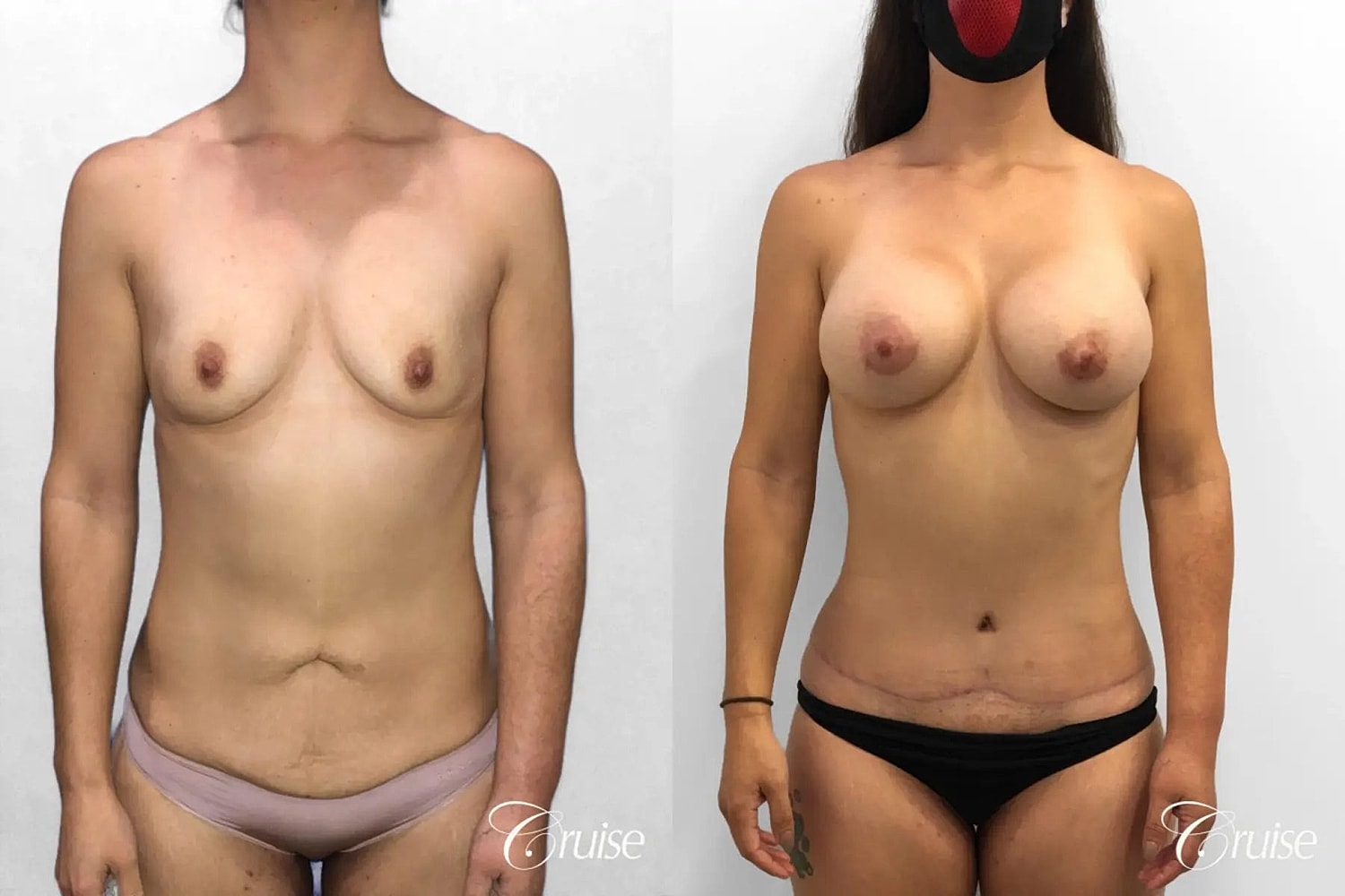 Mommy Makeover Before & After