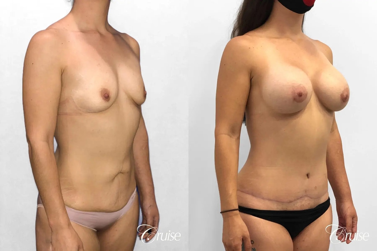 Mommy Makeover Before & After