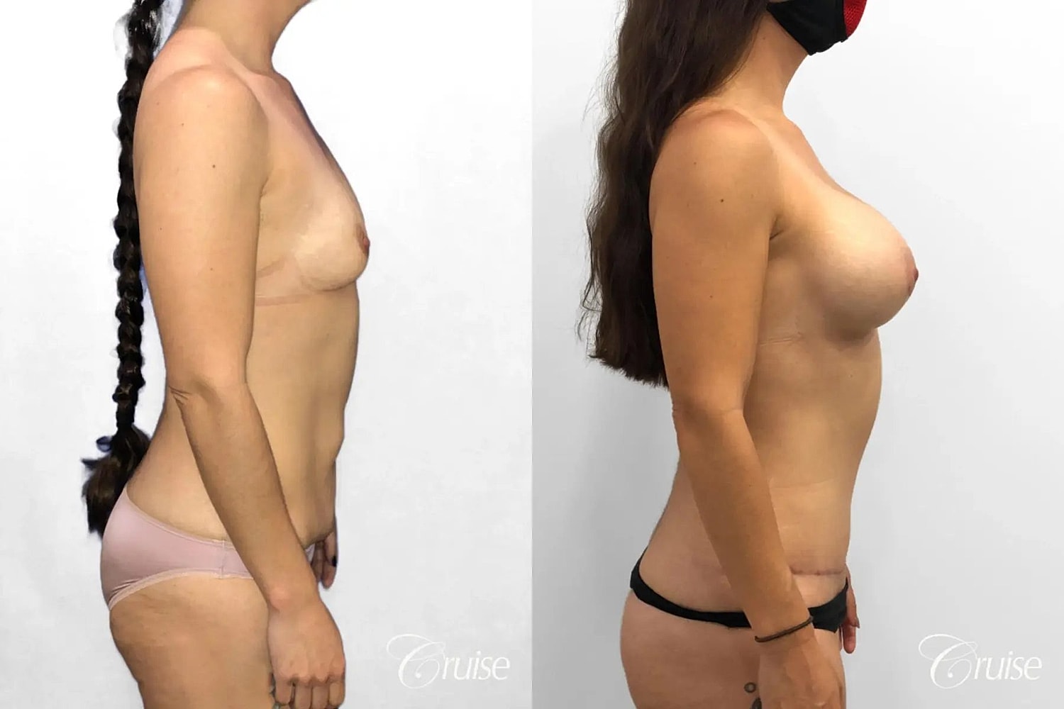 Mommy Makeover Before & After