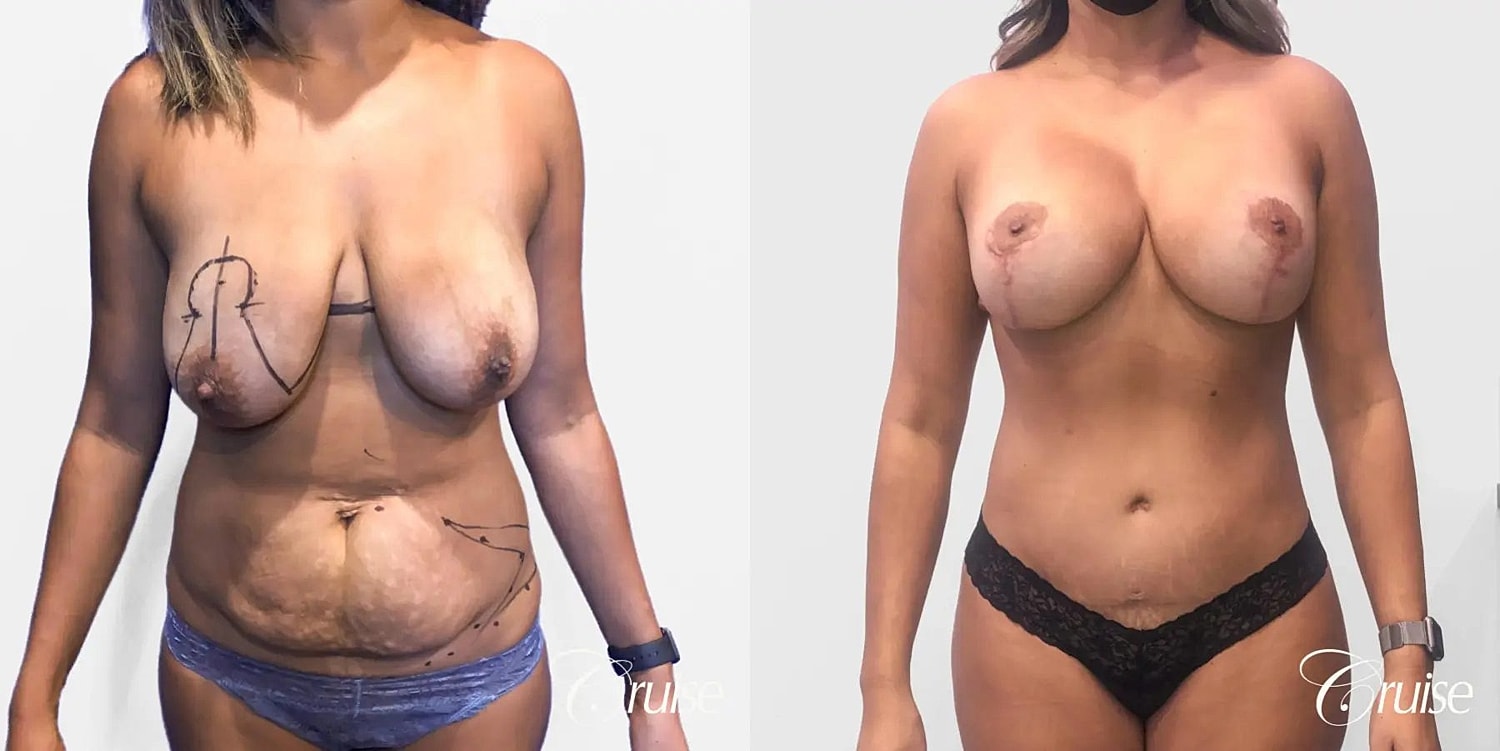 Mommy Makeover Before & After