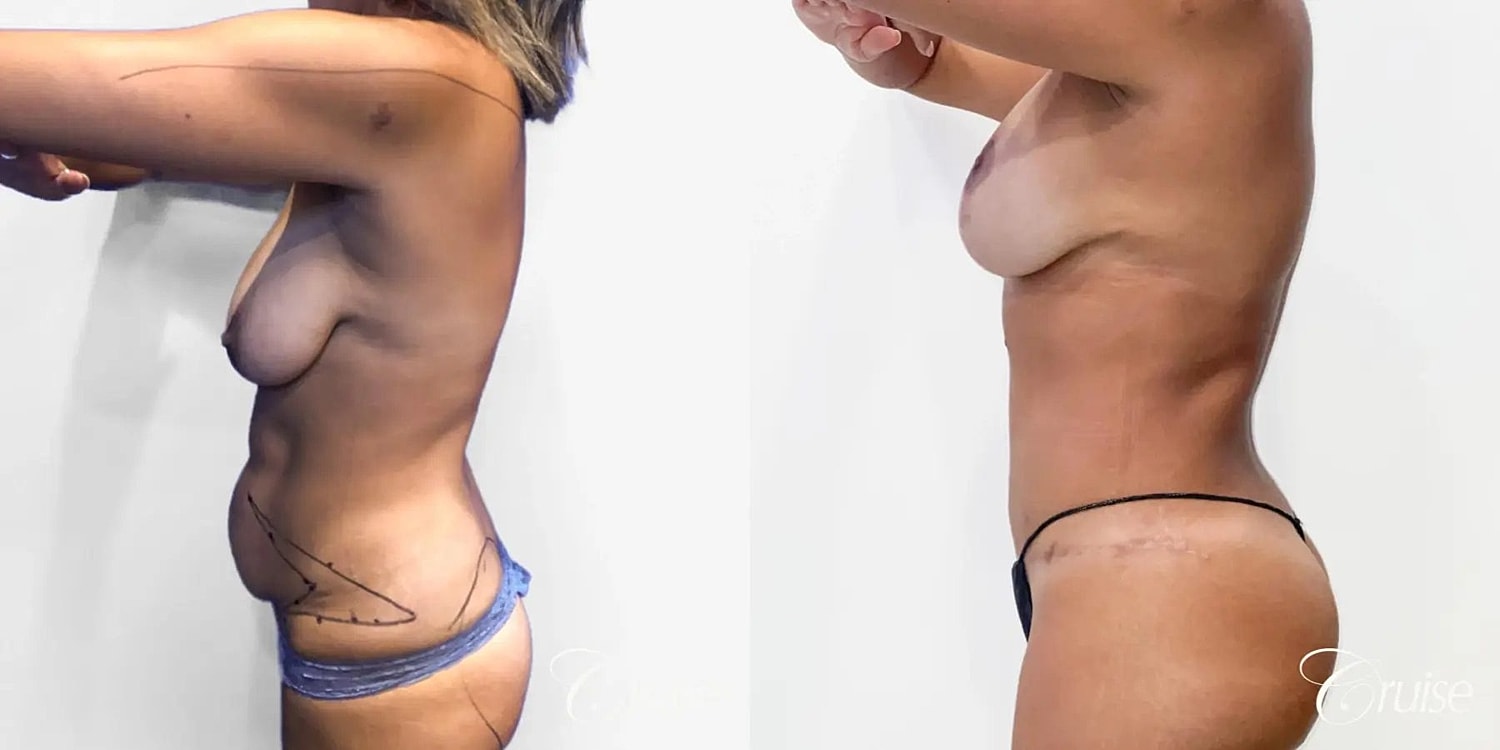 Mommy Makeover Before & After