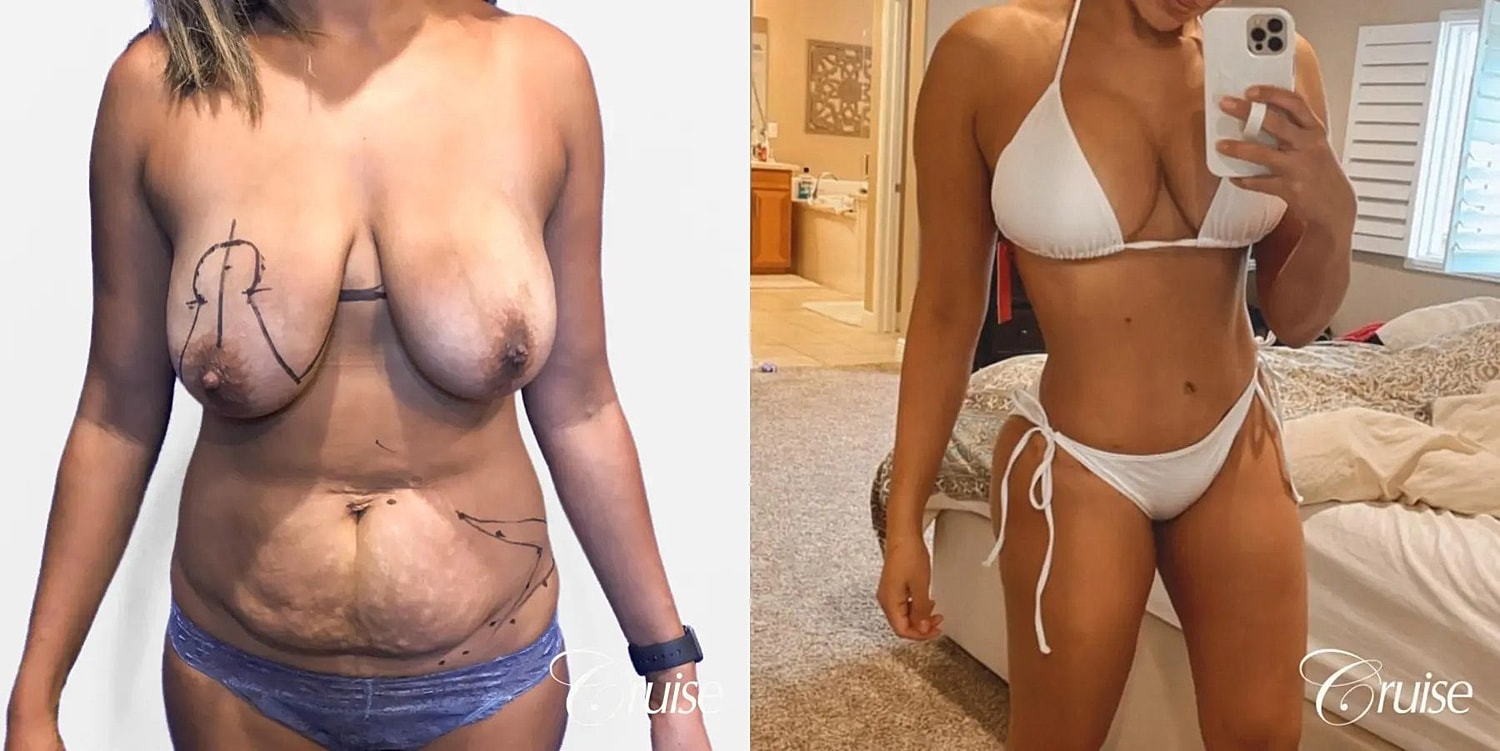 Mommy Makeover Before & After